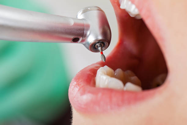 Best Chipped Tooth Repair Near Me  in Belle Glade, FL
